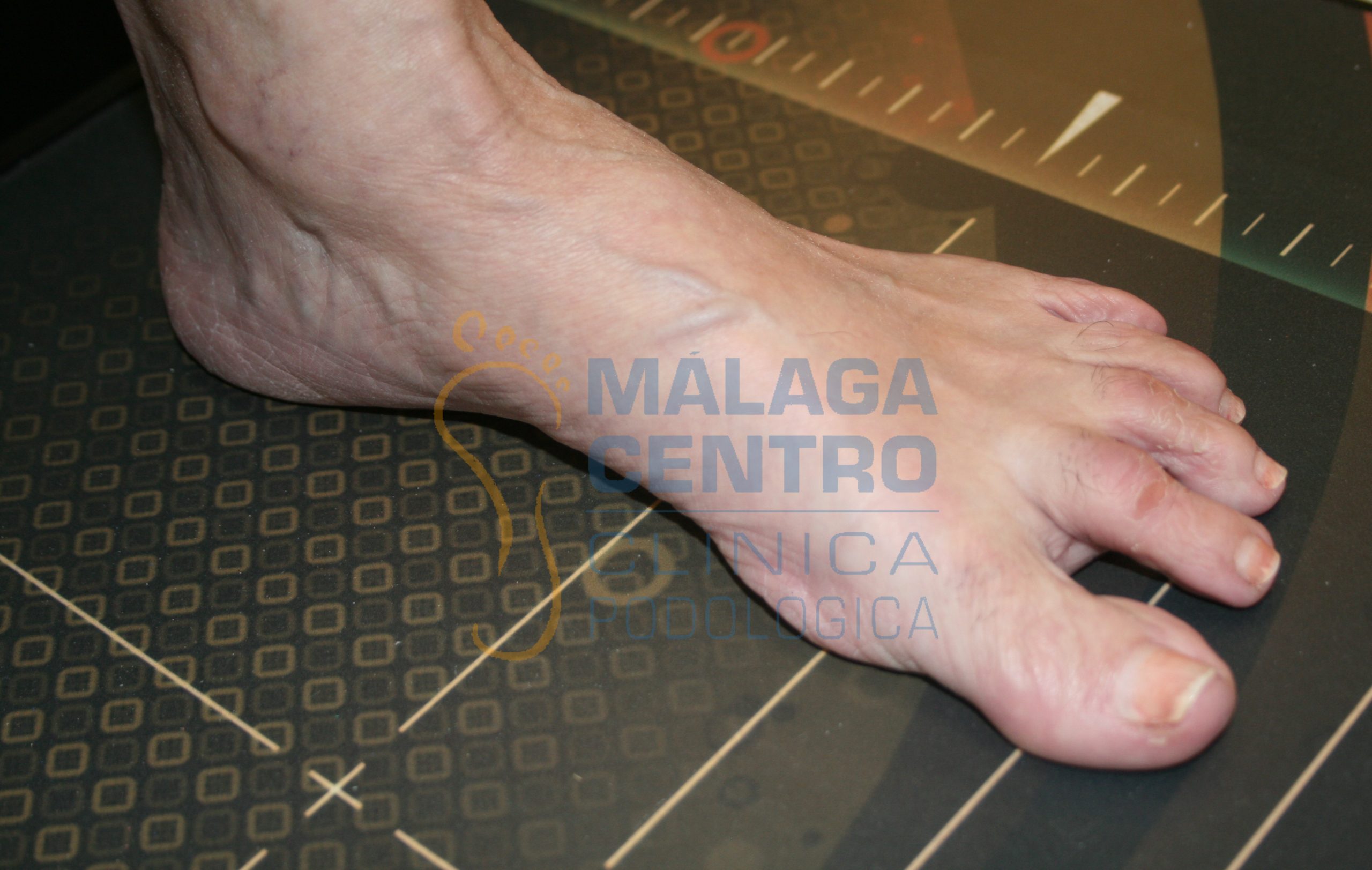 Cirugía De Dedos En Garra Clínica Podológica Málaga Centro 9059